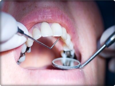 iltihaplı diş ağrısına ne iyi gelir?